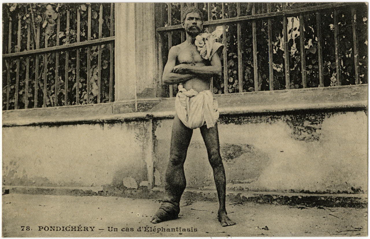 Pondichéry. Un cas d'éléphantiasis. Sou.19.146.1 Photo